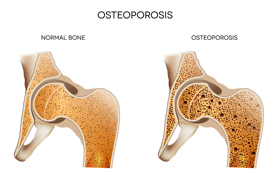 Personal Care at Home in Osakis, MN: Osteoporosis and Seniors